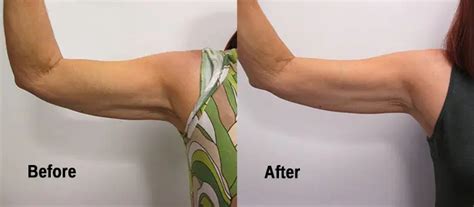 seattle velashape|velashape arms.